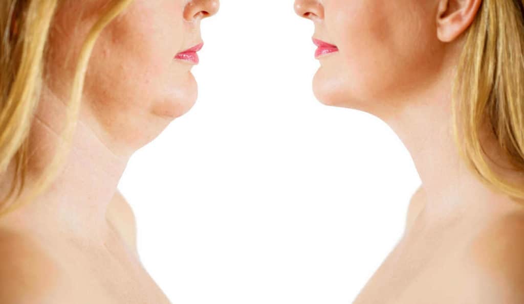 Double Chin treatment Stourport-on-Severn before and after results
