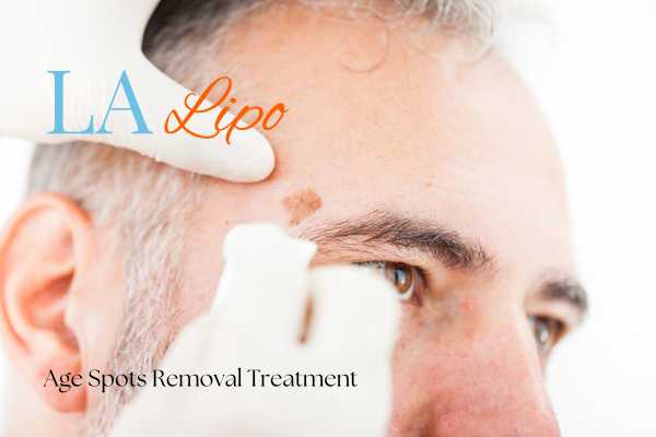 What Are the Most Effective Treatments for Age Spots Stourport-on-Severn?