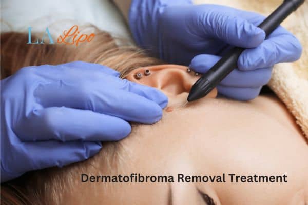 Dermatofibroma Removal Treatment Stourport-on-Severn