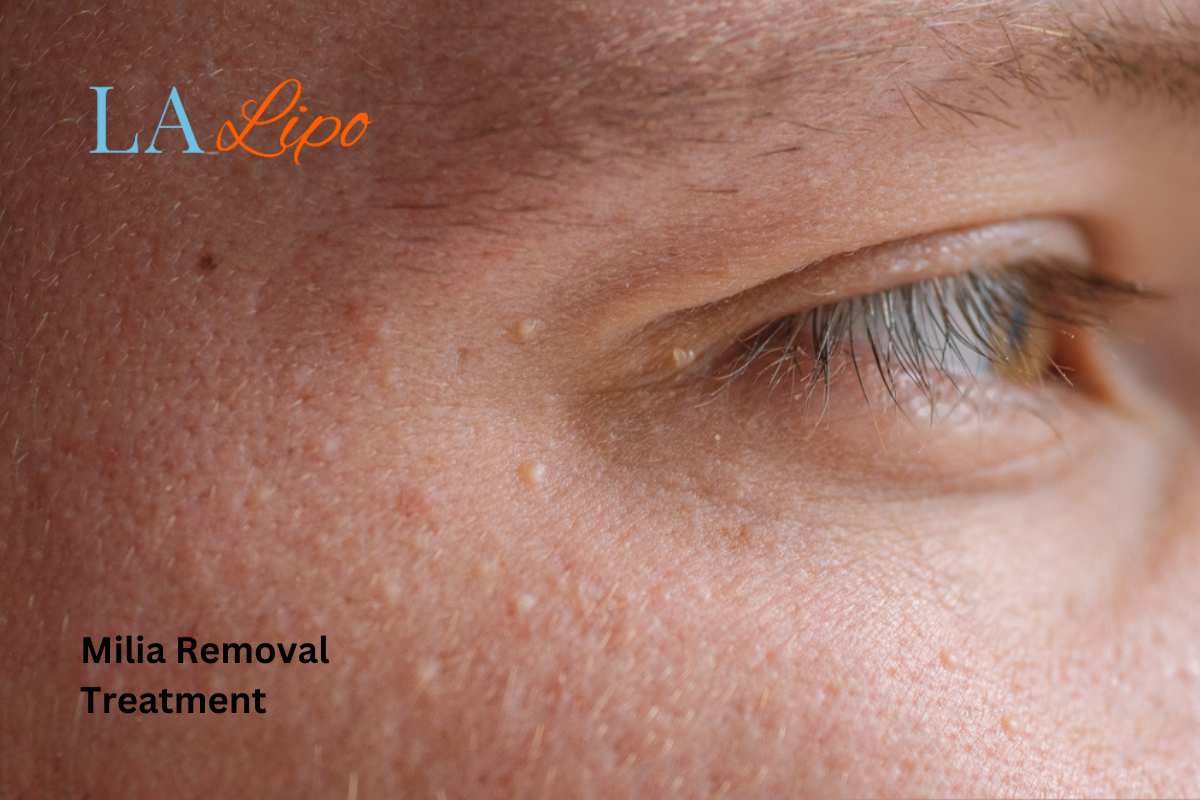 Cryopen Milia Removal: Is It the Easiest and Safest Option Stourport-on-Severn?