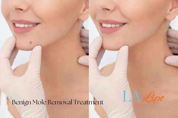 Before-and-after results following benign mole-removal treatment Stourport-on-Severn