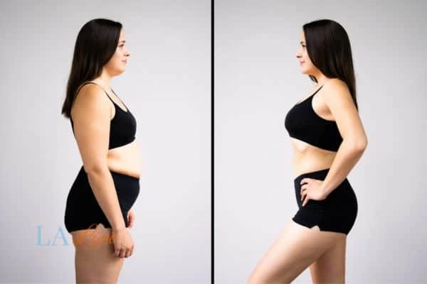 image of woman before and after results of LA-EMS Body Sculpting Stourport-on-Severn to help treat Diastasis recti
