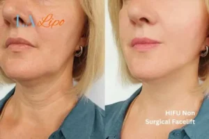 hi-fu for wrinkles Stourport-on-Severn before and after results