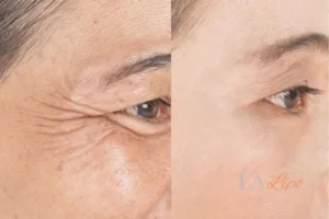 Before and after results of woman - HI-fu wrinkles reduction treatment Stourport-on-Severn