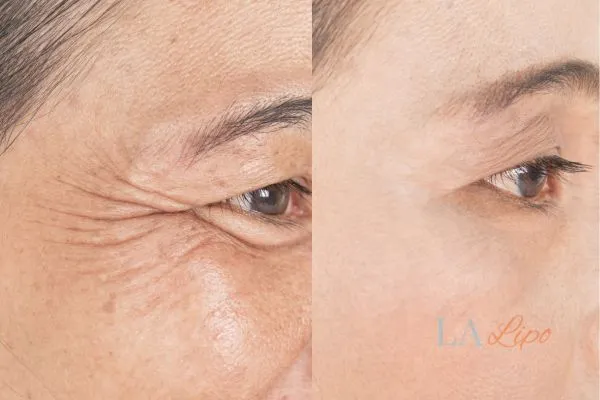 Before and after results of woman - HI-fu wrinkles reduction treatment Stourport-on-Severn