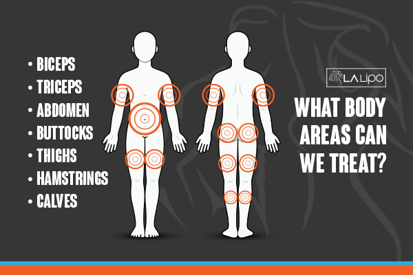 Graphic to show areas you can have LA-EMS Body Sculpting Stourport-on-Severn treatment.