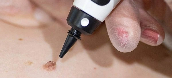 skin tag removal using cryopen Stourport-on-Severn