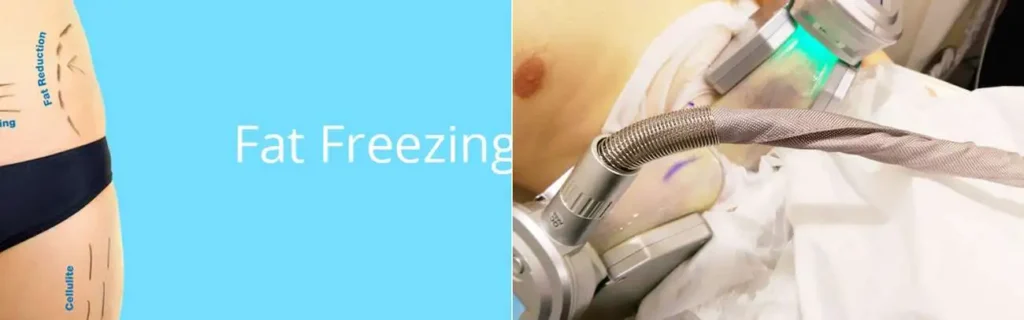 Fat freezing Stourport-on-Severn on multiple areas of the body