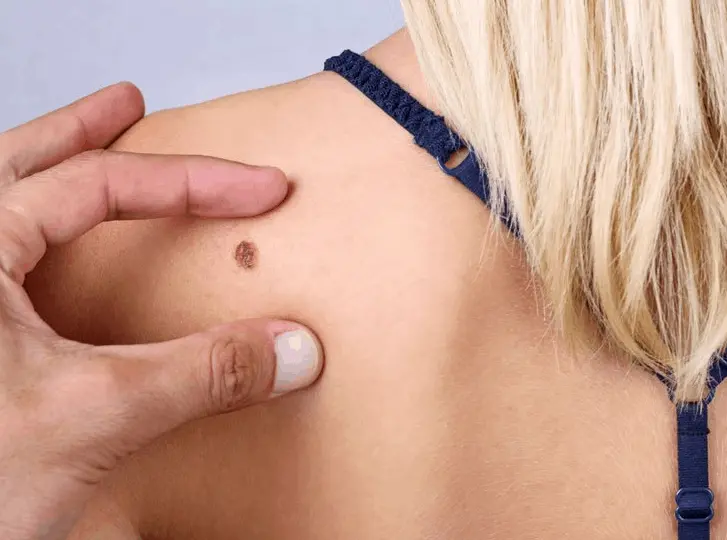 woman having mole removal Stourport-on-Severn consultation before treatment.