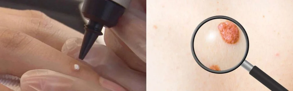CryoPen practitioner Stourport-on-Severn assessing a benign mole before treatment