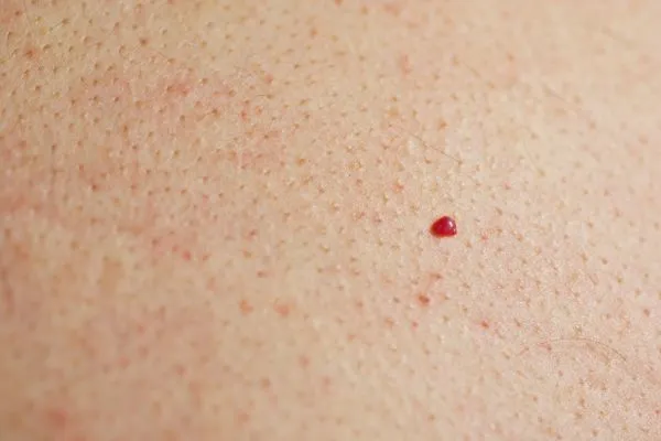close up of a cherry angioma Stourport-on-Severn