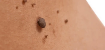 image of a skin tag Stourport-on-Severn