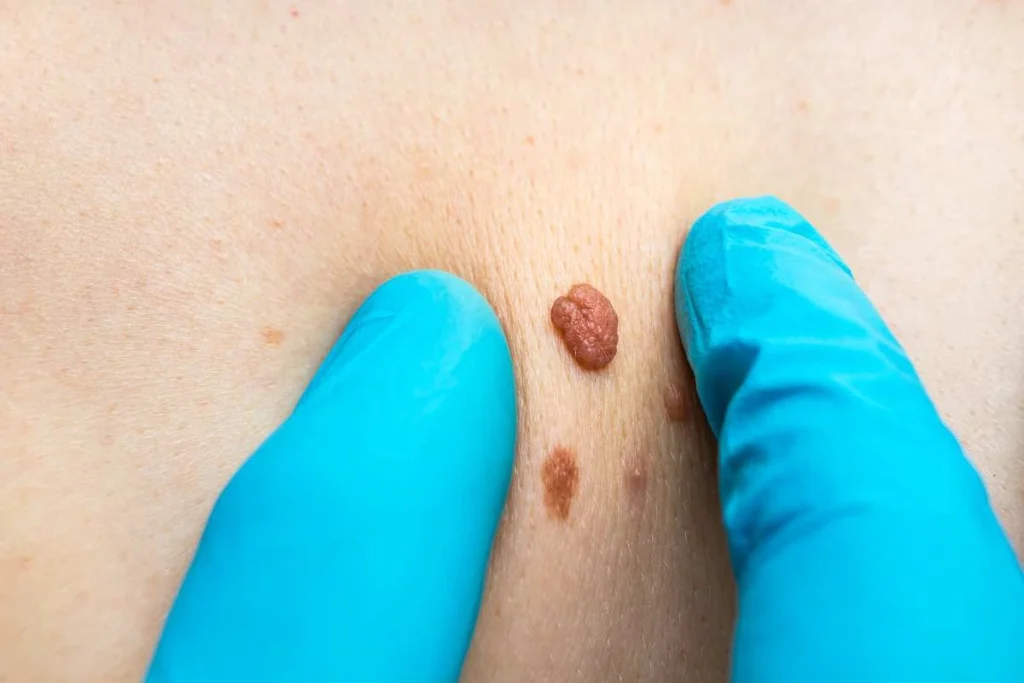 Consultant examining a skin tag Stourport-on-Severn