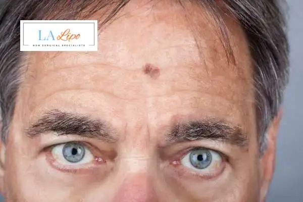 Solar Lentigo Removal Stourport-on-Severn image of man with mark on his forehead