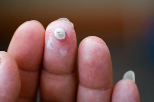wart on person finger - cryotherapy to treat from LA LIPO Stourport-on-Severn