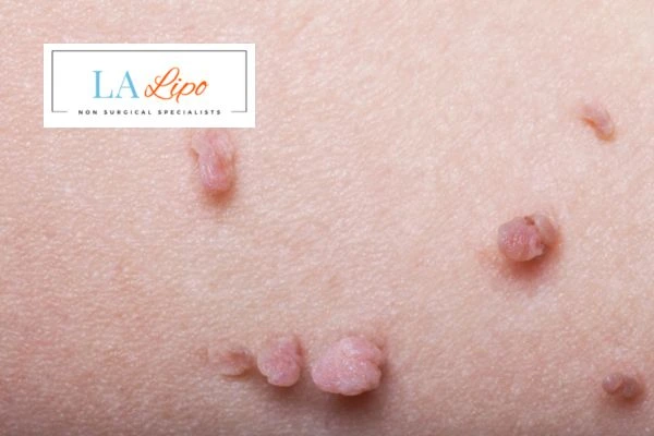 Does cryopen skin tag removal Stourport-on-Severn hurt? Find out now call our team today!