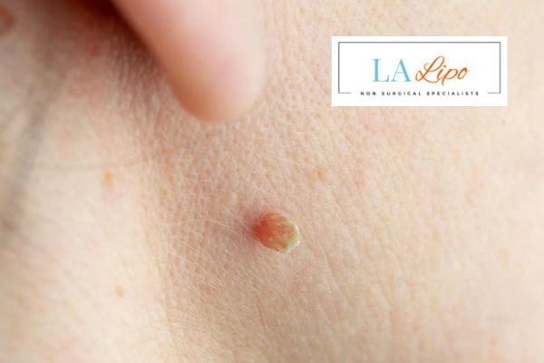 Book skin tag removal Stourport-on-Severn today speak to our team now!