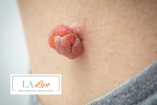 Interested in skin tag removal Stourport-on-Severn? Concerned about the pain? Find out more today!