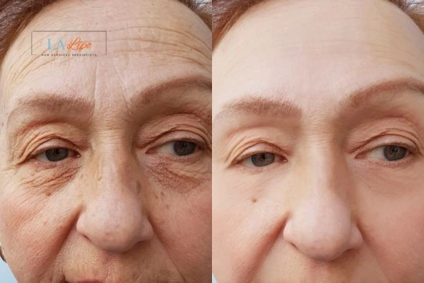 The powerful benefits of Morpheus8 Treatment Stourport-on-Severn - Call Our team today!