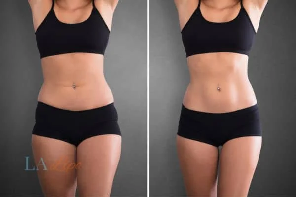 before and after results of non-surgical treatment to help a woman's body image and mental health Stourport-on-Severn