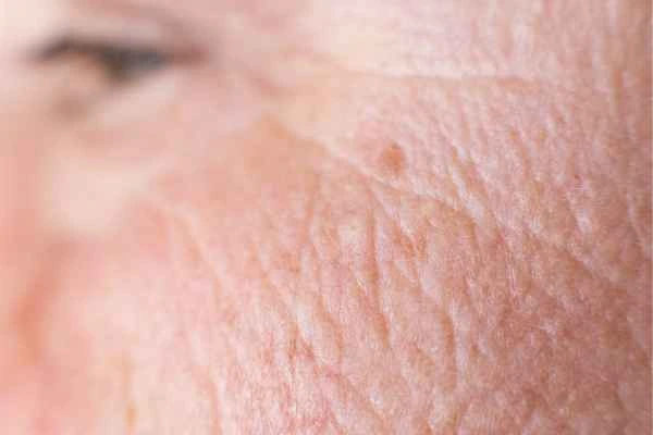 close up picture of a woman's face showing an age spot Stourport-on-Severn
