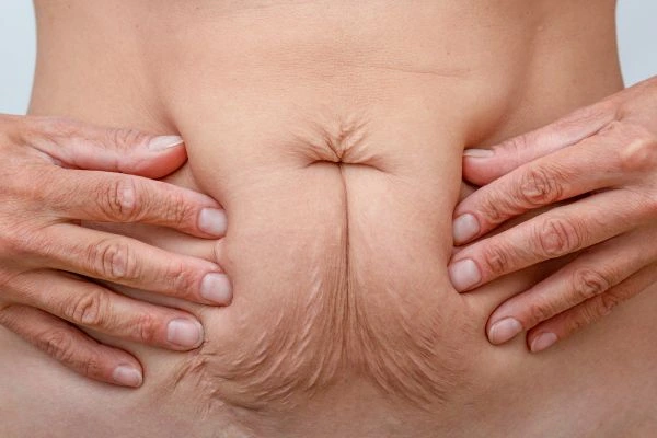 Image of a woman's stomach with loose skin - example of skin tightening Stourport-on-Severn options