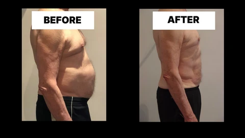What Symptoms Can Diastasis Recti Cause in Men? Weak Core, Back Pain and Poor Posture Stourport-on-Severn